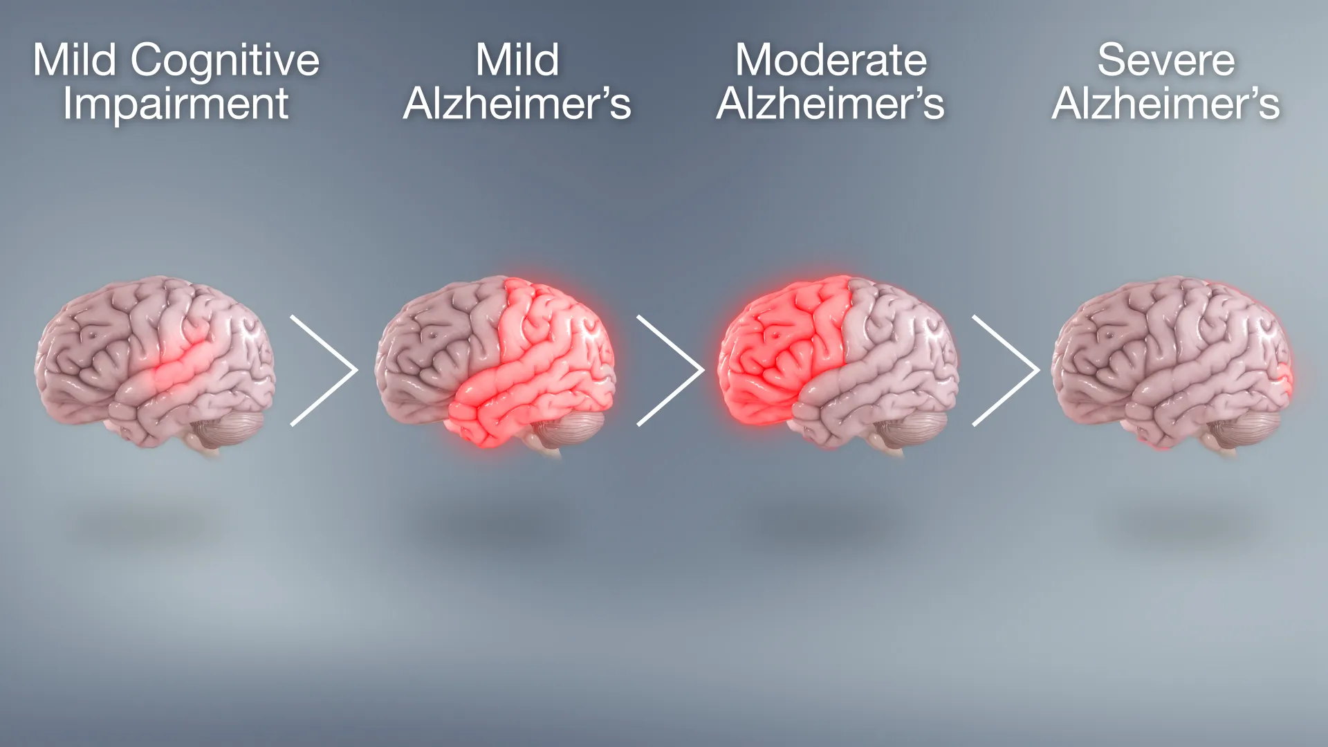 Progression of Alzheimer's disease through different stages